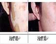 什么是泛发型白癜风