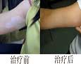 治疗节段型白癜风的注意