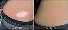广州腹部白癜风治疗时要